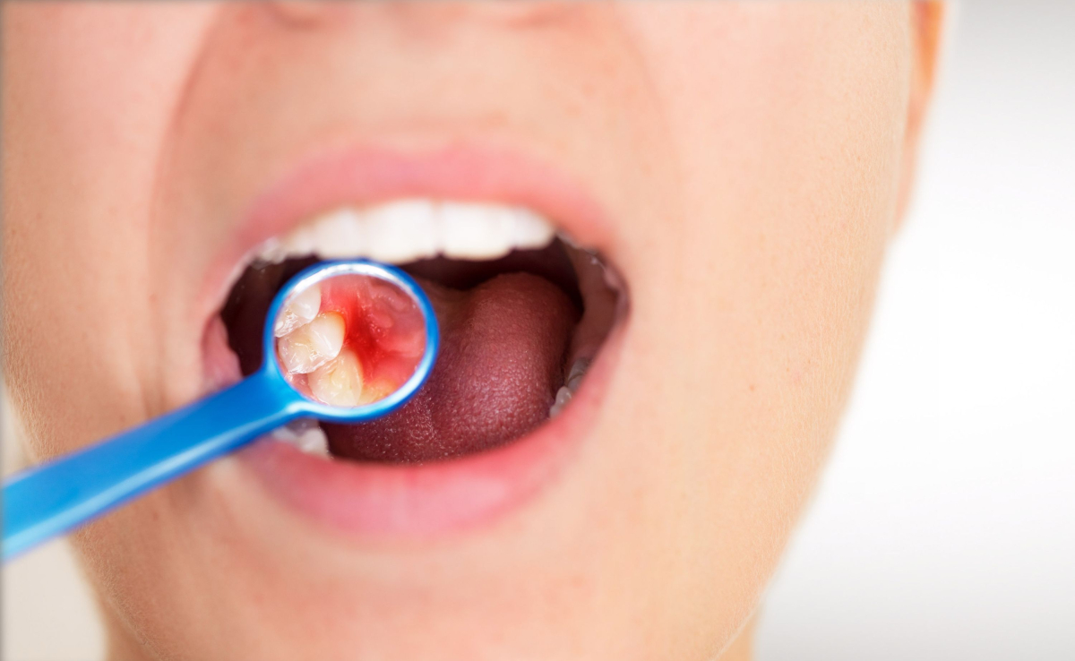 Cicha epidemia zbiera fatalne żniwo. Popularne napoje dosłownie „rozpuszczają” zęby Polaków