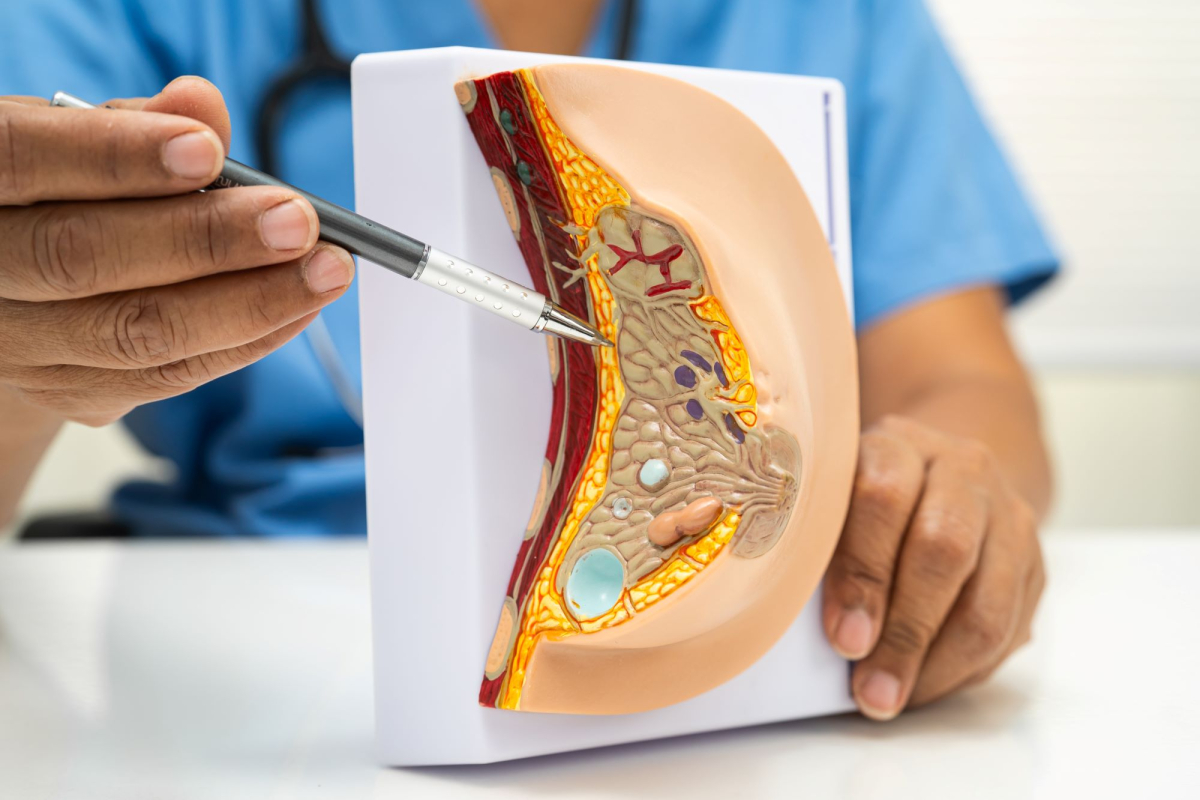 Wpływ diety na rozwój raka piersi