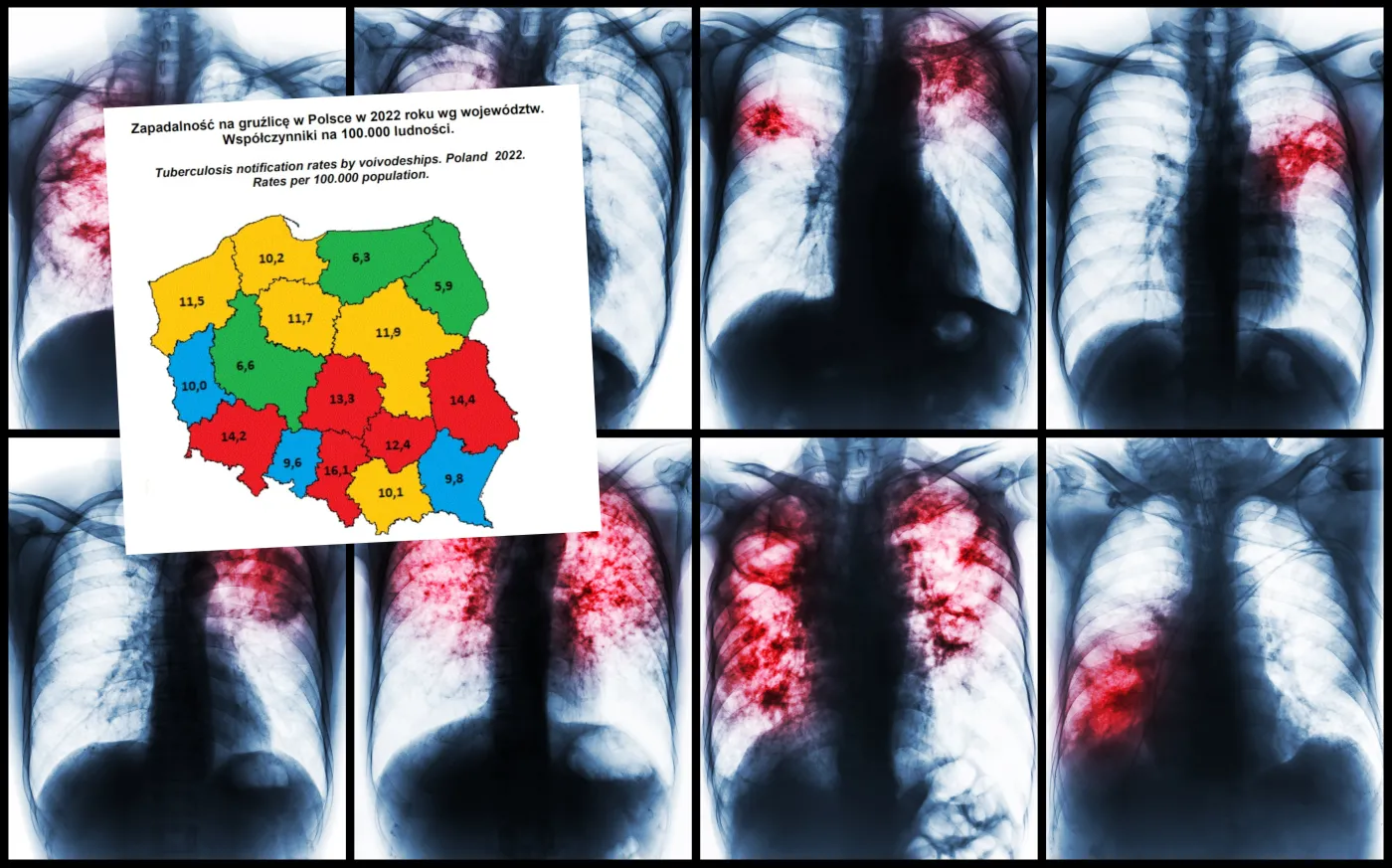 Gruźlica zabija już częściej niż COVID-19