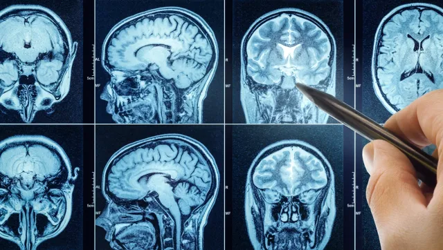 ADHD to nie jedna choroba? AI odkryła dwa skrajnie różne typy zaburzenia w mózgu