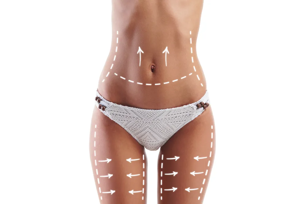 Rozważasz liposukcję? Sam zabieg na dłuższą metę niczego nie załatwi