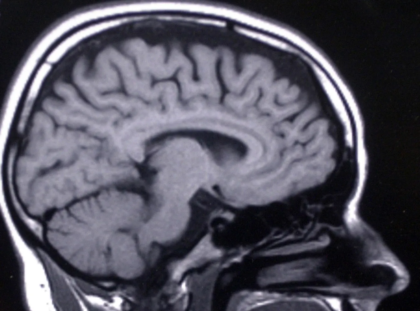 Rewolucja w wykrywaniu choroby Alzheimera