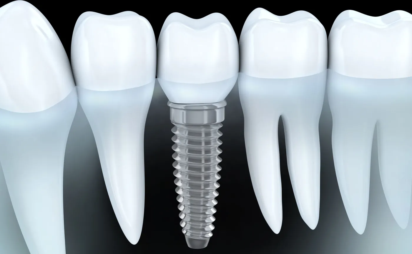 Implanty stomatologiczne – prawdy i mity