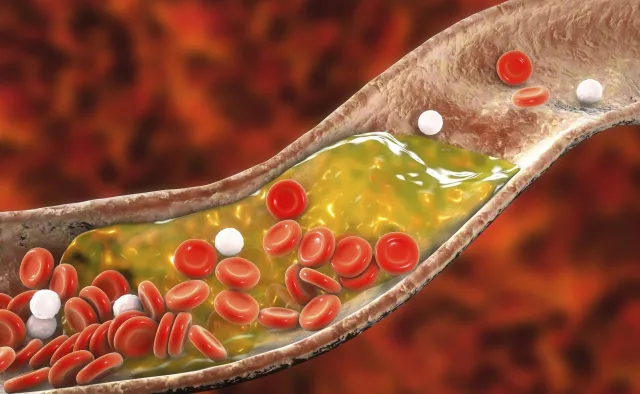 Wysoki poziom cholesterolu pomaga rozwijać się nowotworom