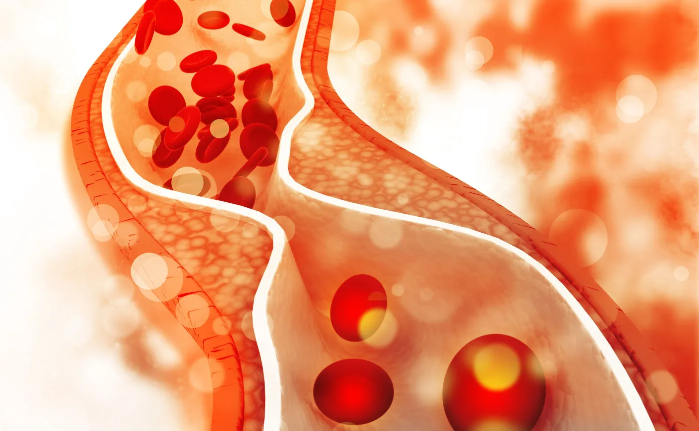 21 mln Polaków ma zbyt wysoki poziom cholesterolu, grożący zawałem i udarem