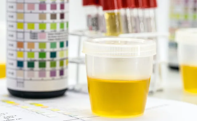 Prosty test moczu może ujawnić alzheimera we wczesnej fazie rozwoju