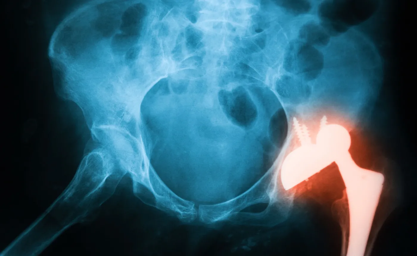 Zmiany na rynku implantów ortopedycznych w Polsce: MedTech Solutions z wyłącznością na implanty GPC Medical