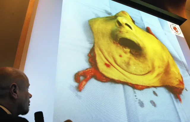 Pierwszy przeszczep twarzy w Polsce. Lekarze pokazali ZDJĘCIA