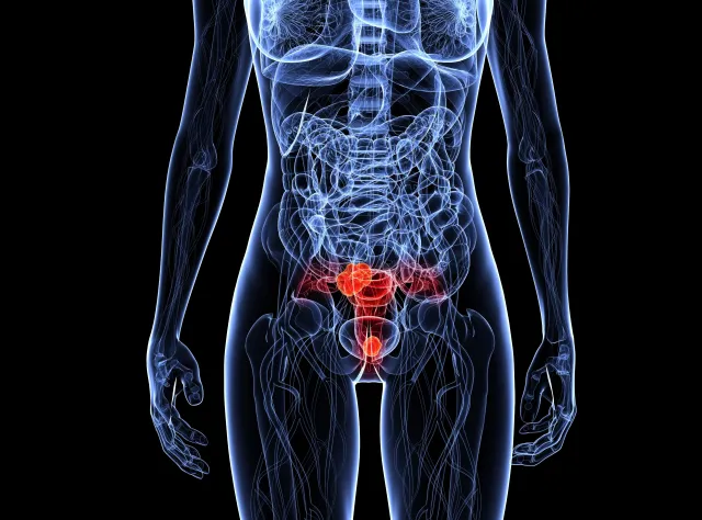 Rak szyjki macicy rozwija się bezboleśnie i długo. To trzeba o nim wiedzieć!