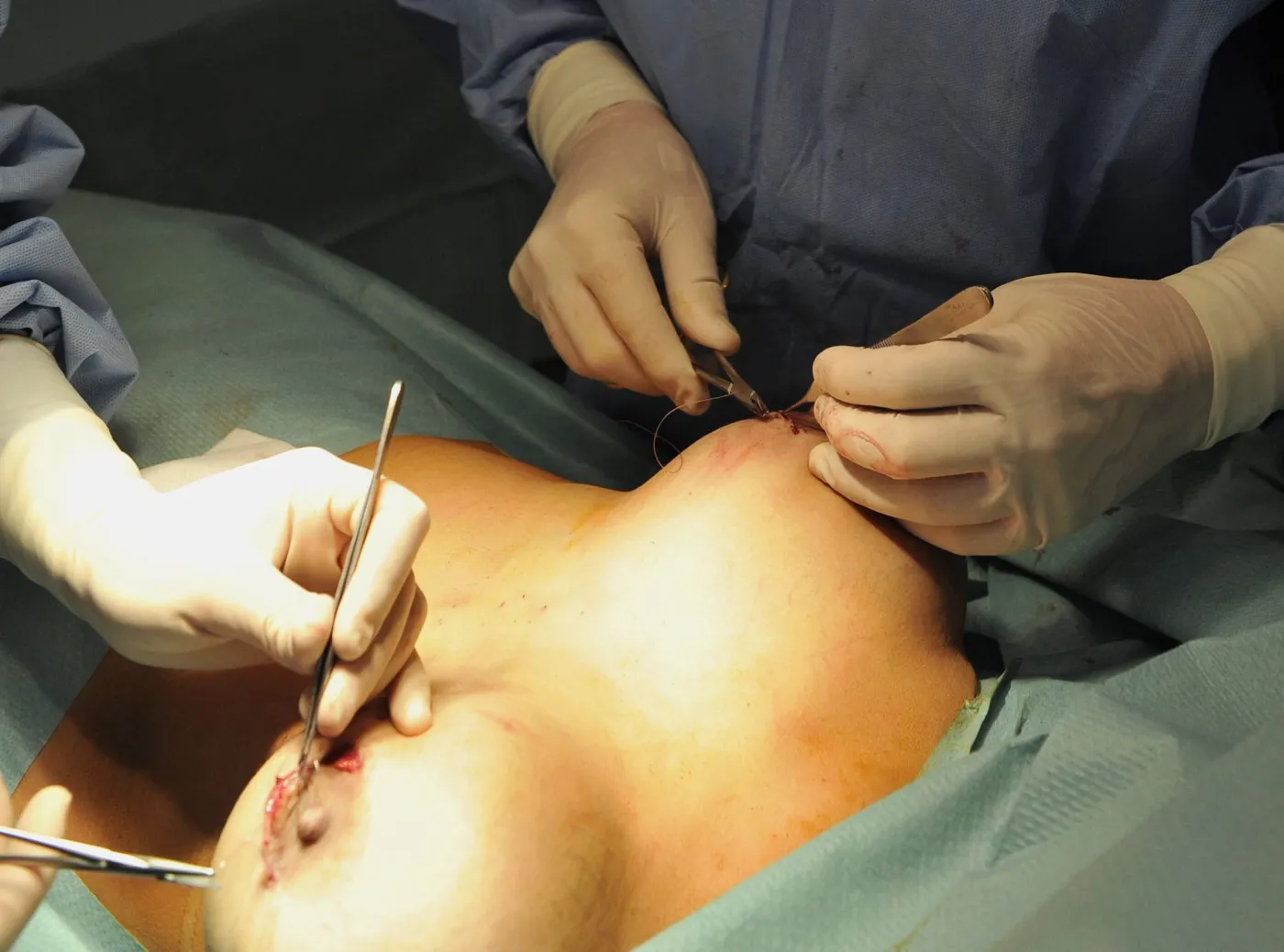 2956824-operacja-usuniecie-silikonowych.jpg
