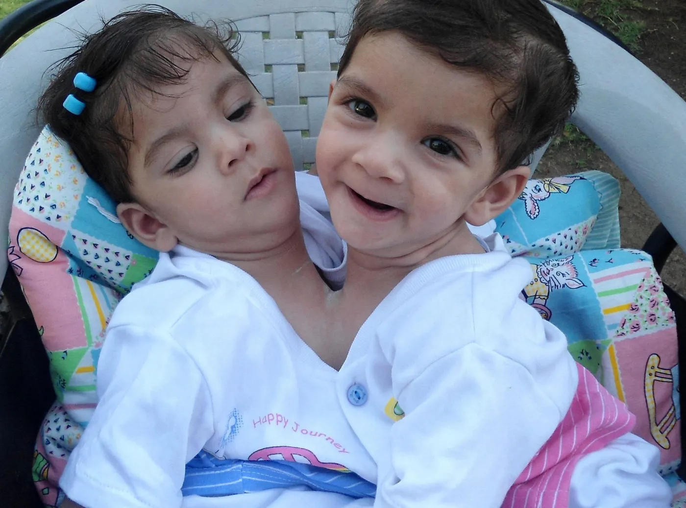 bliźniaczki syjamskie w Indiach