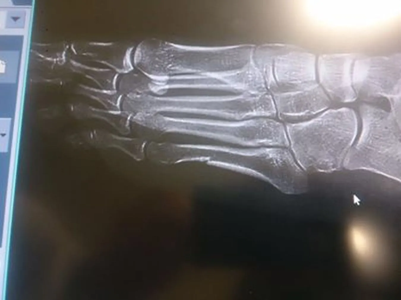 Norwegowie nie wierzą w złamaną stopę Kowalczyk. Podważają autentyczność zdjęcia