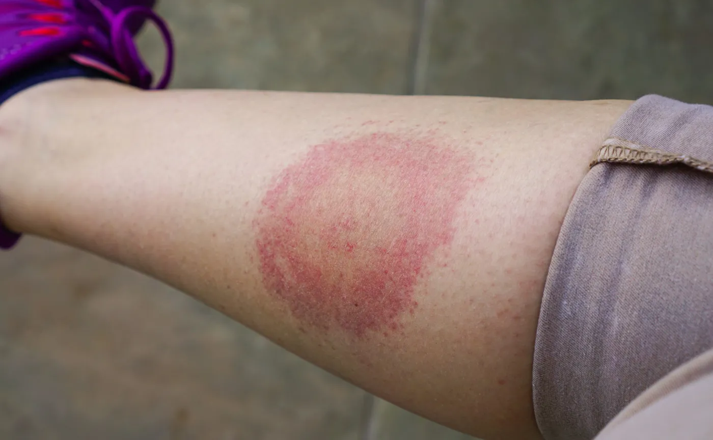 Kiedy ukąszenie kleszcza jest groźne. BORELIOZA: Od objawów po leczenie