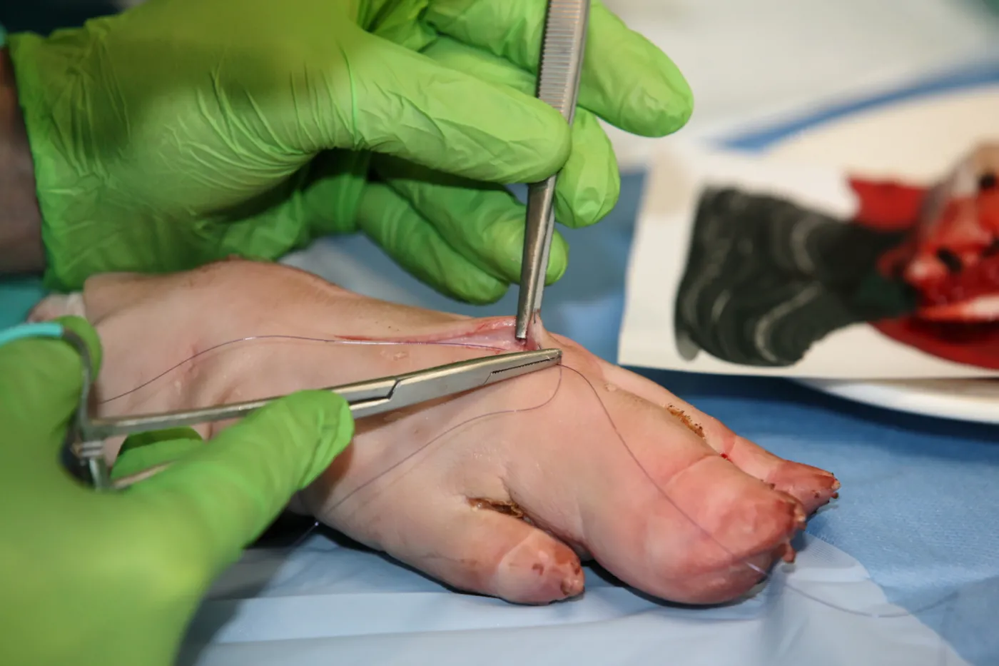 MISTRZOSTWA POLSKI W SZYCIU CHIRURGICZNYM