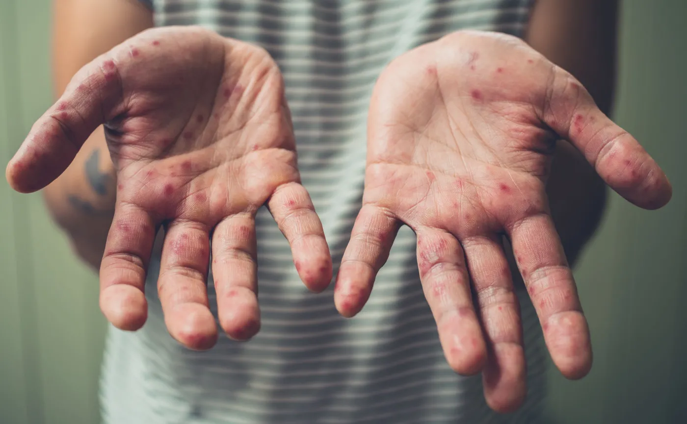 Odra. Wysypka po zakażeniu