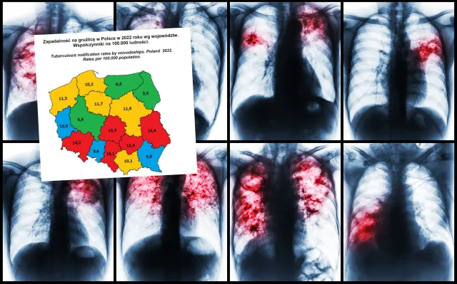 Wraca zapomniana choroba, do Polski także. W ubiegłym roku zabiła więcej osób niż COVID-19