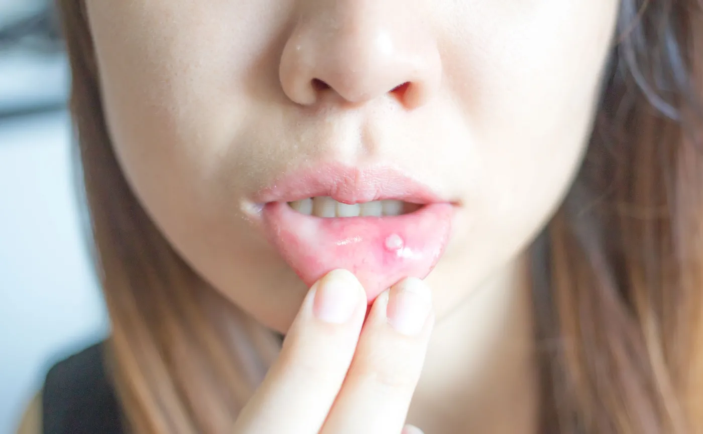 Najlepsze sposoby na afty