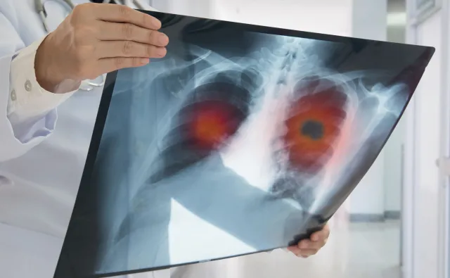 Specjaliści chorób płuc alarmują: W czasie pandemii niemal zaprzestaliśmy diagnozowania raka płuca