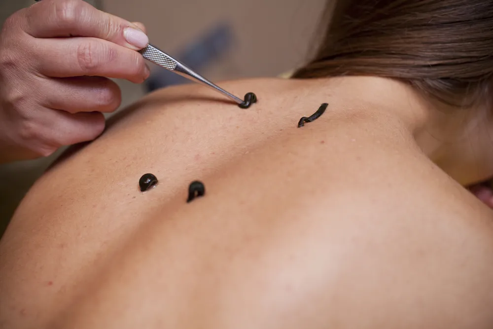 W czasie pandemii trzykrotnie wzrosła sprzedaż pijawki lekarskiej