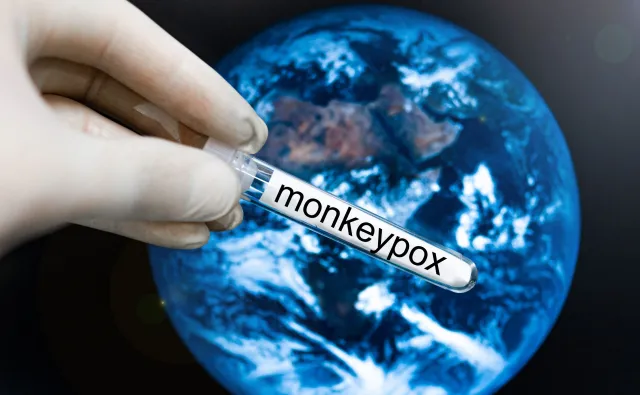 Kto jest zagrożony zgonem z powodu małpiej ospy? Ekspertka wskazuje grupę