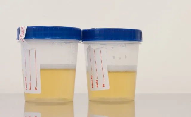 Test moczu pomoże wykryć raka prostaty i uniknąć biopsji