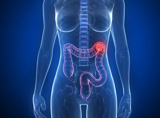 "Duża jest dynamika wzrostu zachorowalności na ten nowotwór"