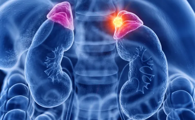 Problemy w leczeniu NADCIŚNIENIA? Winne mogą być nadnercza