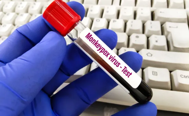 Małpia ospa w Polsce. Ile osób choruje? "Więcej niż wynika z oficjalnych statystyk"