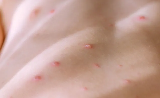 Znaczący wzrost zachorowań na ospę. OBJAWY