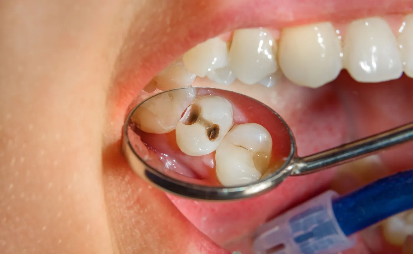 Próchnica? Nie zawsze do borowania