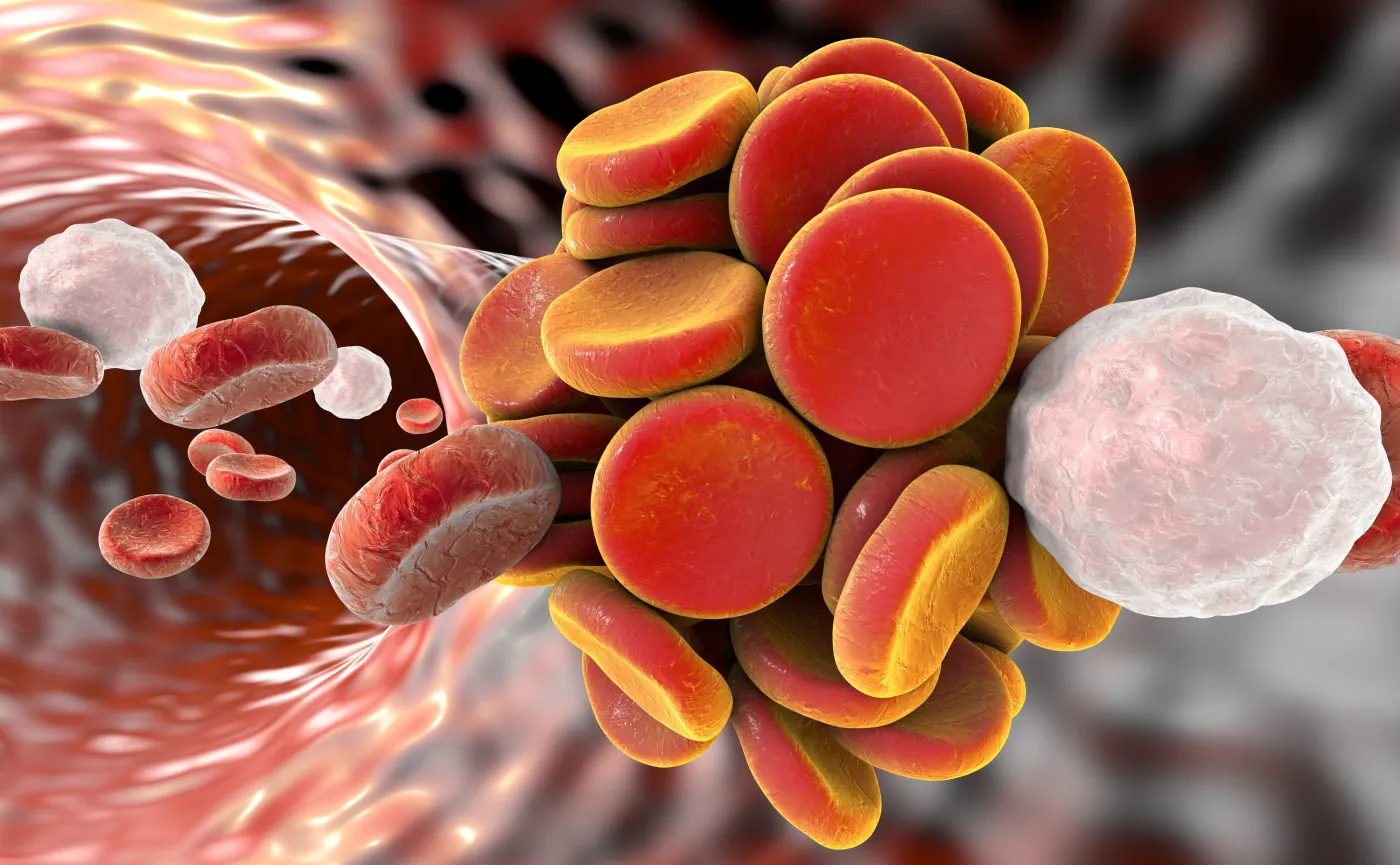 Żylna choroba zakrzepowo-zatorowa zbiera tragiczne żniwo. OBJAWY