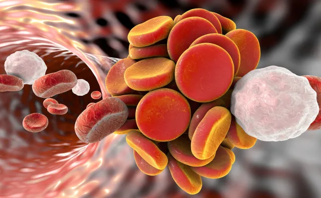Żylna choroba zakrzepowo-zatorowa zbiera tragiczne żniwo. OBJAWY