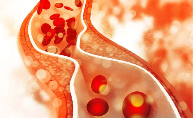 21 mln Polaków ma zbyt wysoki poziom cholesterolu, grożący zawałem i udarem