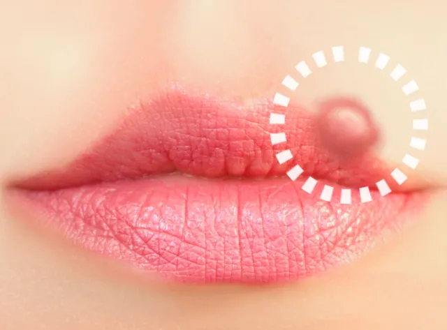 Co robić, gdy opryszczka nie odpuszcza. Przepisy na lecznicze mazidła