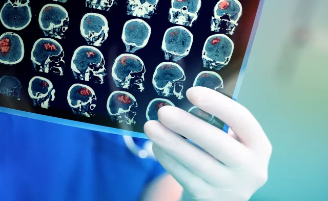 Objawy glejaka. Sprawdź, jakie objawy daje ten rak mózgu