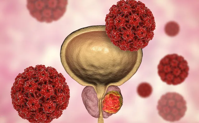 Najczęstszy nowotwór wśród mężczyzn: RAK PROSTATY. Jak go skutecznie leczyć?