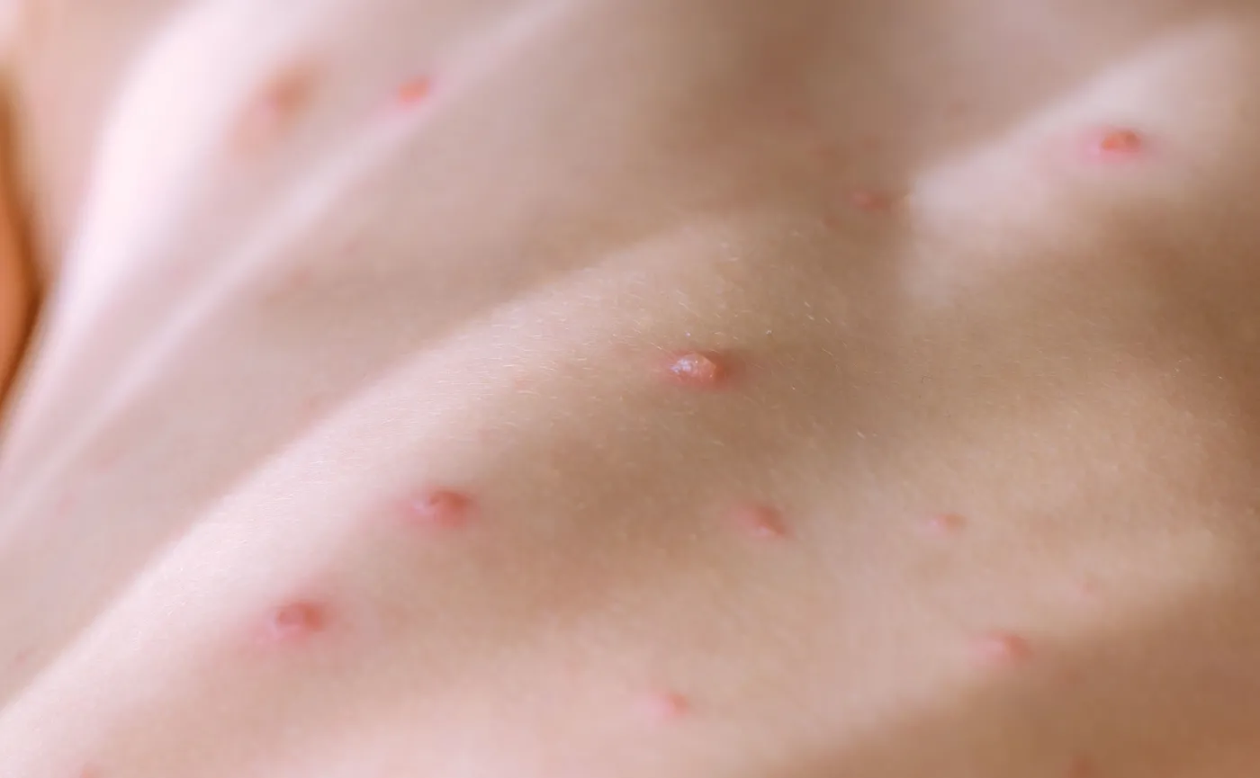 Znaczący wzrost zachorowań na ospę. OBJAWY