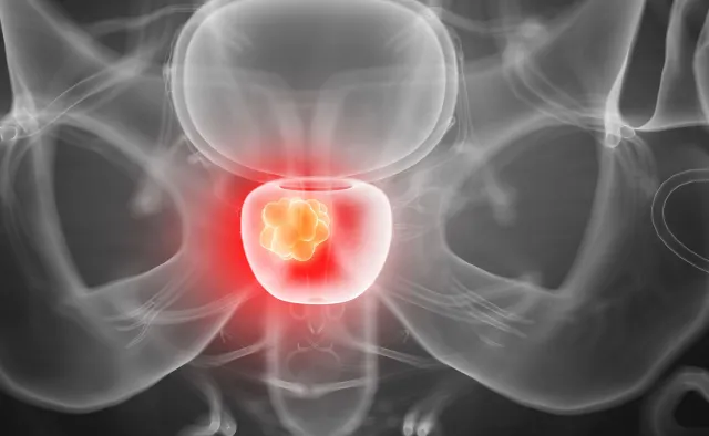 Już nie rak płuc! Ten nowotwór jest największym zabójcą mężczyzn w Polsce