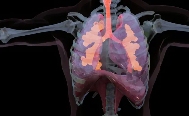 Zapalenie oskrzelików wywołane RSV szczególnie niebezpieczne u...