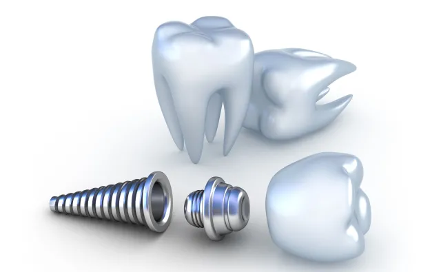 Utracony ząb? Te fakty o implantach zębów musisz znać