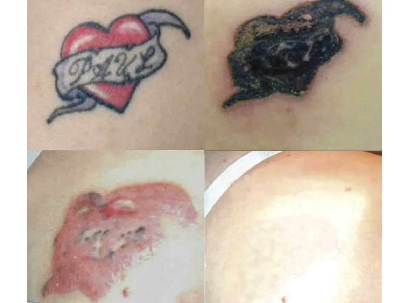 Usuń swoje tatuaże... kremem