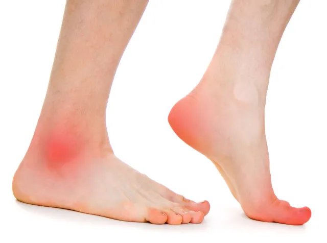 Jak opatrywać pęcherze i otarcia? Pierwsza pomoc