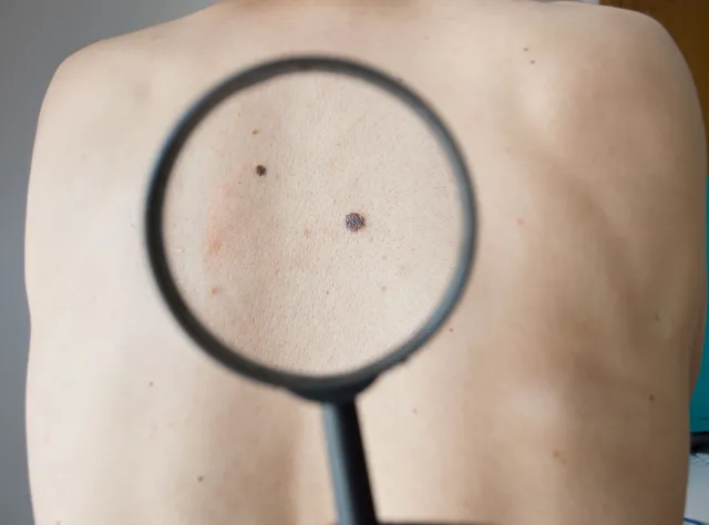 Rak skóry atakuje ze zdwojoną siłą. Dlaczego?