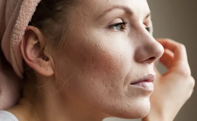 Nie leczymy, bo nie znamy trądziku różowatego