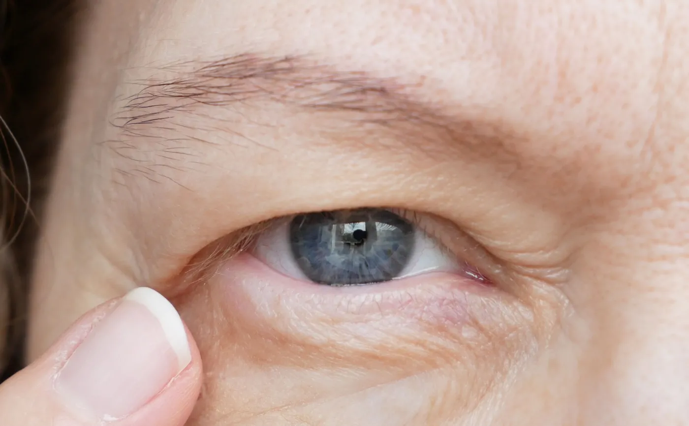 MIASTENIA to bagatelizowana choroba, które może być groźna dla życia. OBJAWY