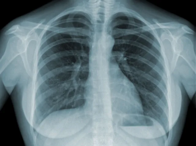 Sztuczna inteligencja może identyfikować COVID-19 w płucach. Na podstawie RTG