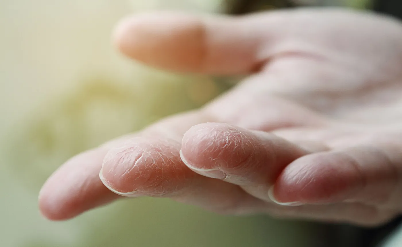 Kobiety chorują na nią aż 4 razy częściej niż mężczyźni: TWARDZINA. Objawy