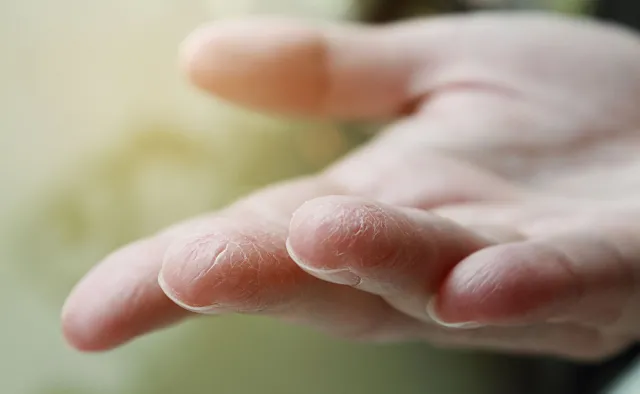 Wymazy ze skóry mogą wykrywać COVID-19