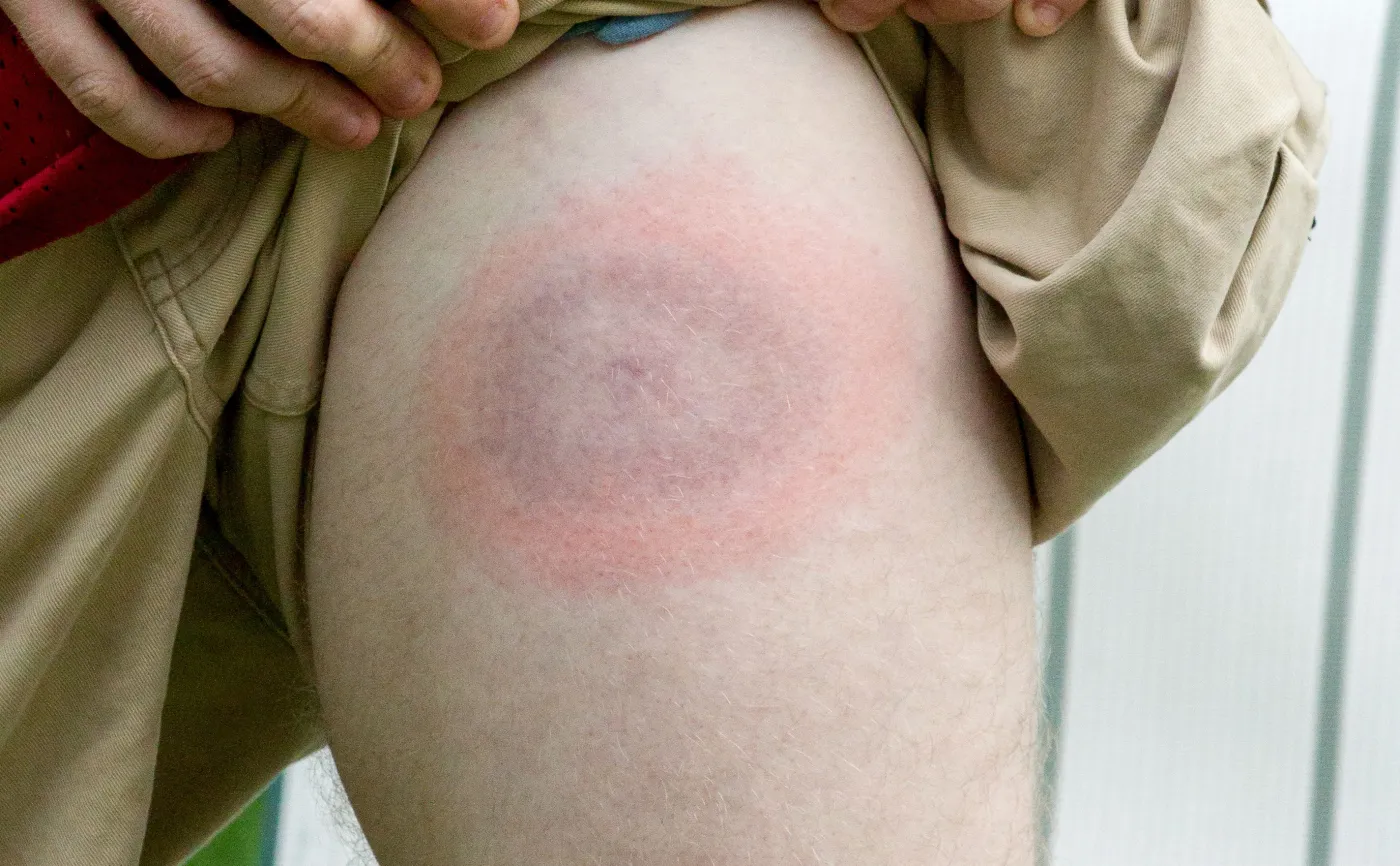 Eksperci wskazują słabe punkty w zaleceniach leczenia BORELIOZY. Są przeciwni stosowaniu...