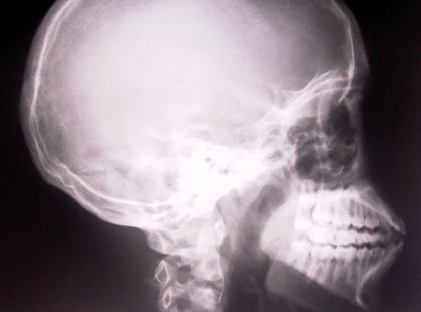 Wyhodowali szczękę w brzuchu pacjenta